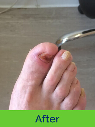 Dorothy J Nolan Podiatry Chiropody Wigan Foot Care Nail Ingrown After