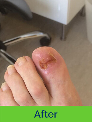 Dorothy J Nolan Podiatry Chiropody Wigan Foot Care Nail Ingrown After