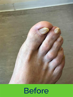 Dorothy J Nolan Podiatry Chiropody Wigan Foot Care Nail Ingrown Before