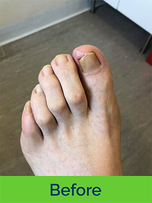 Dorothy J Nolan Podiatry Chiropody Wigan Foot Care Nail Ingrown Before